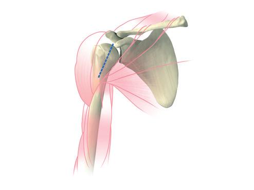 Care should be taken to preserve the origin and insertion of the deltoid. The clavipectoral fascia is incised at the external border of the coraco-brachialis.