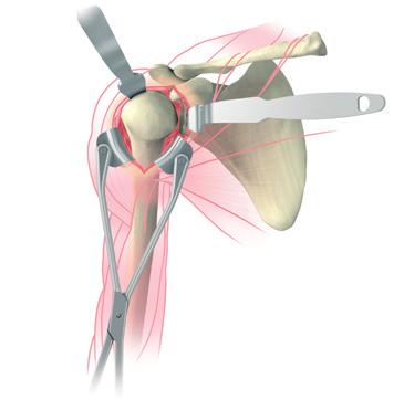 With the arm externally rotated, a conservative anterior and inferior capsule release from the humerus to the glenoid may be performed.