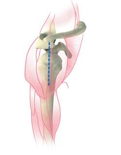 In cases of severely restricted external rotation (0 or less), it is recommended to further release the upper pectoralis insertion.