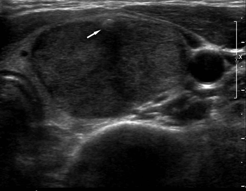 Sonographic findings and the pathologic diagnosis were correlated according to the size and location of the nodule and the calcification pattern described in the pathology report.