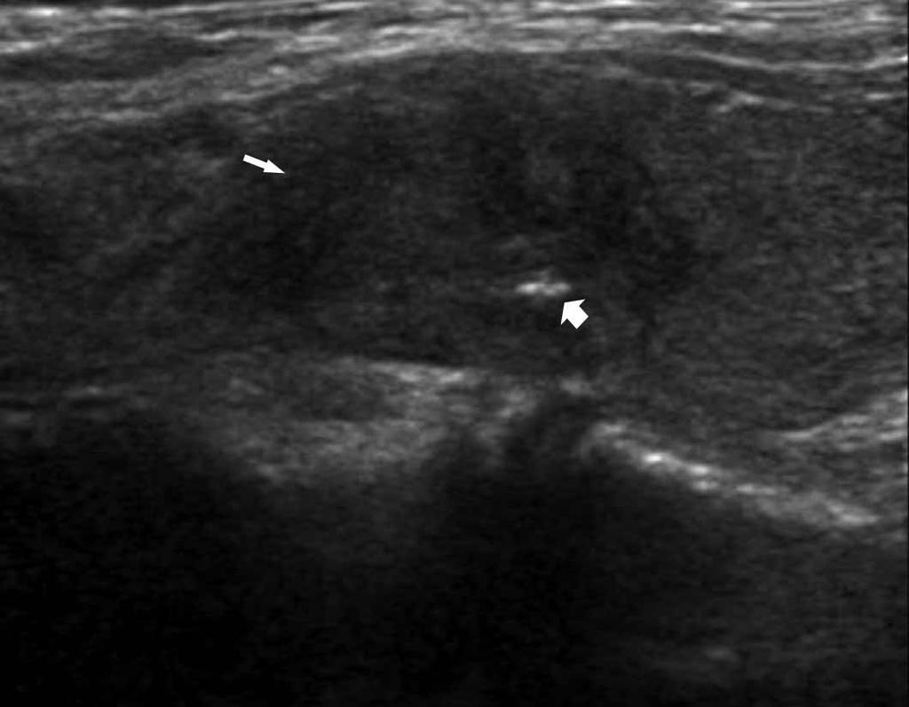 Differentiation of Thyroid Nodules With Macrocalcifications Discussion Figure 3.