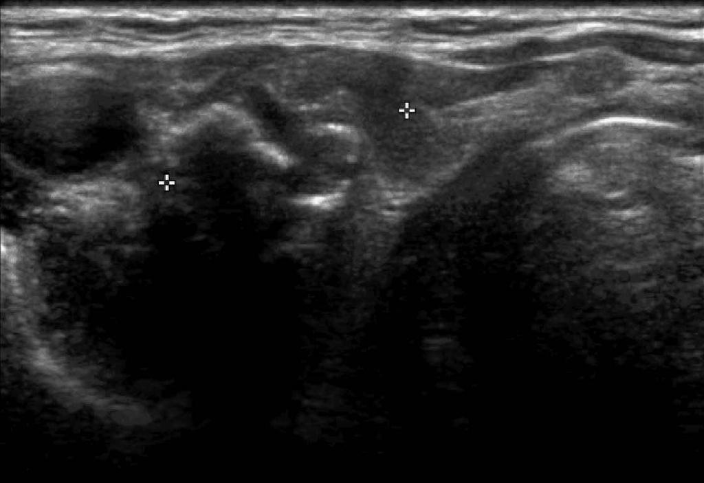 Kim et al the presence of calcifications and the sonographic characteristics of nodules considered, they did not present statistical data to support their conclusion.