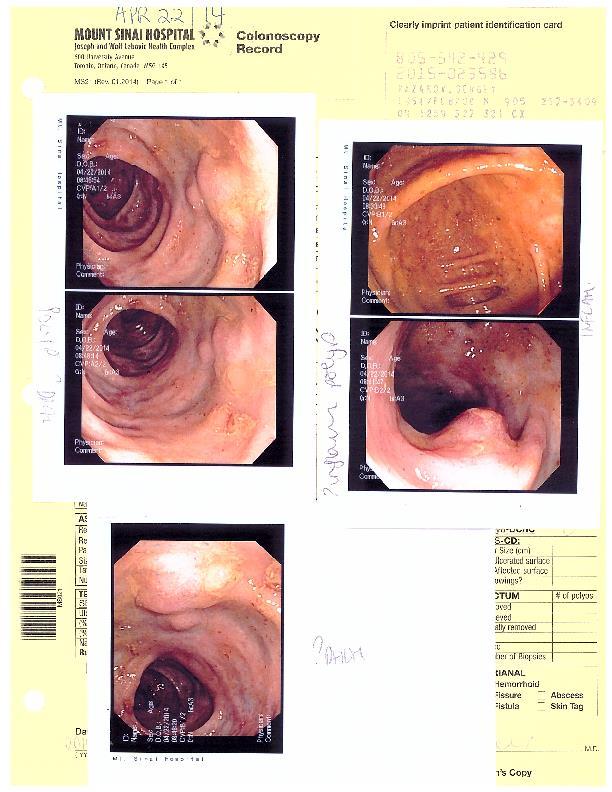 Colonoscopy April 2014 Flat lesions