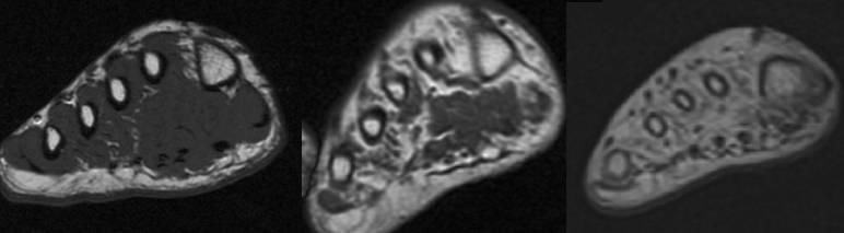 24 Figure 2 MRI of the foot and calf muscles in