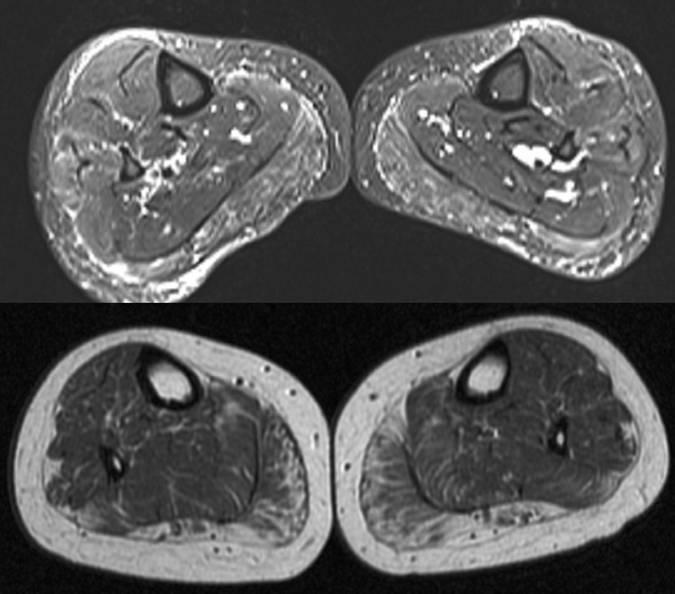 weighted images showing fatty infiltration in the