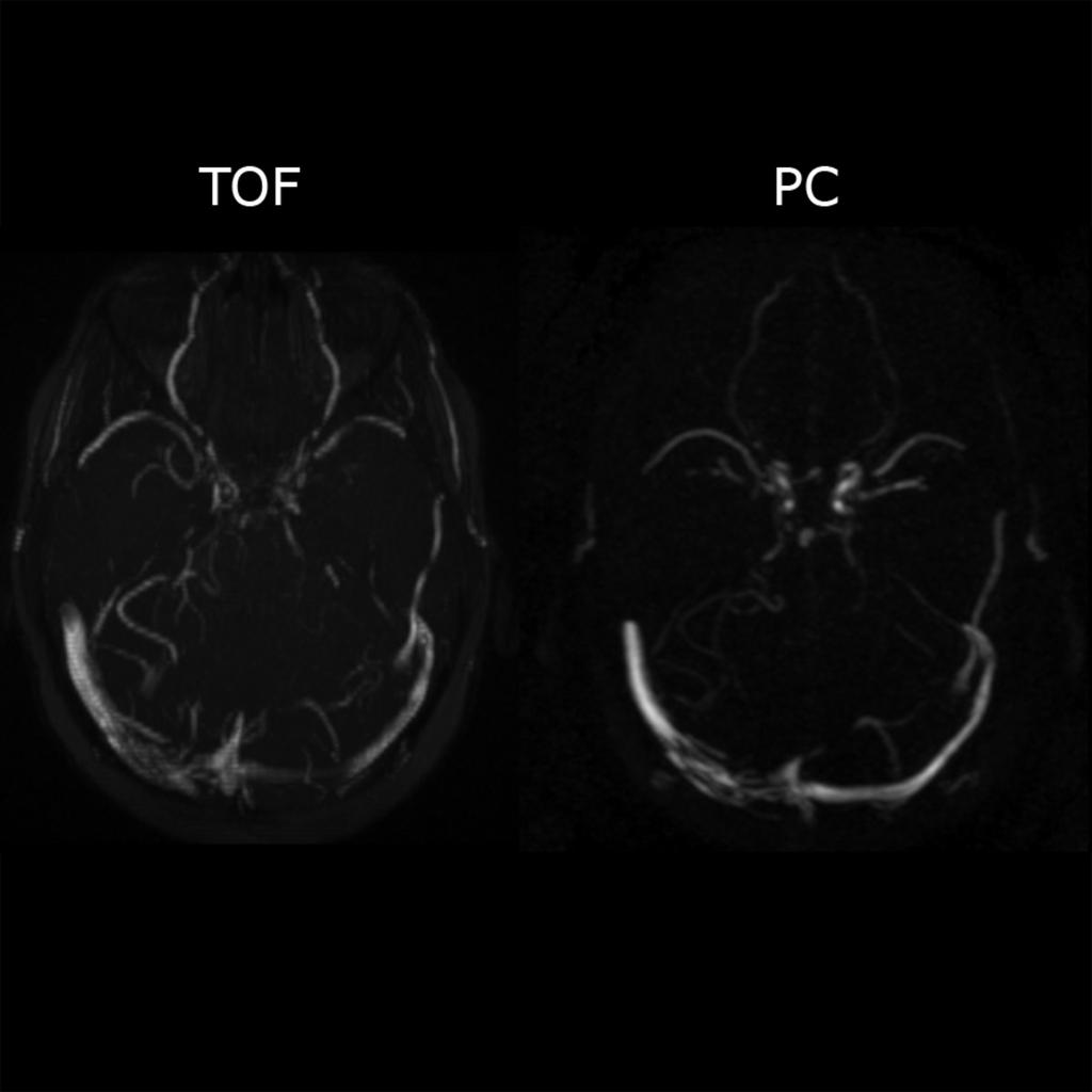 Fig. 1: 22 year-old female with history of venous sinus thrombosis (initially diagnosed 3 weeks prior to displayed images).