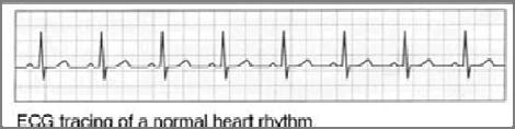Crackles, Dull lung sounds (pleural effusion) Variable pulse quality +/- Jugular