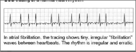 Irregularly irregular rhythm Irregular R-R intervals Absent P waves Presence of