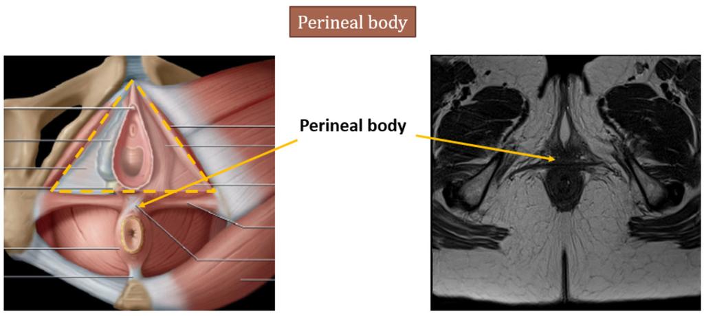 A very important element to take notice in the MRI examination is the perineal body a fascial condensation posterior to the vagina, attachment site of perineal muscle and external anal sphincter. Fig.