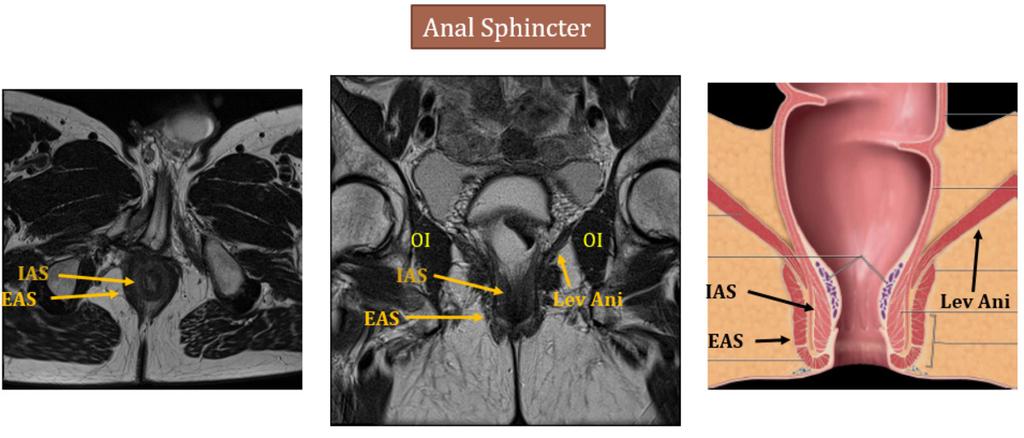 Fig. 11: Lev Ani - levator ani muscle, OI - obturator internus, IAS - internal anal sphincter, EAS - external anal sphincter Right image is adapted from Shaaban AM, et al.