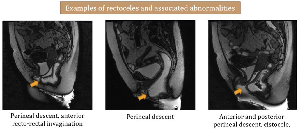 Fig. 48: Arrows - rectoceles Enterocele -Herniation of the pelvic peritoneal sac through the recto-genital space below de pubo-coccigeal ligament or