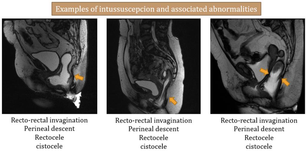 Fig. 25: Arrows - rectal intussusception Left image - schematics of rectal intussusception Middle Image - schematics of rectal prolapse References: Jonas Fig.