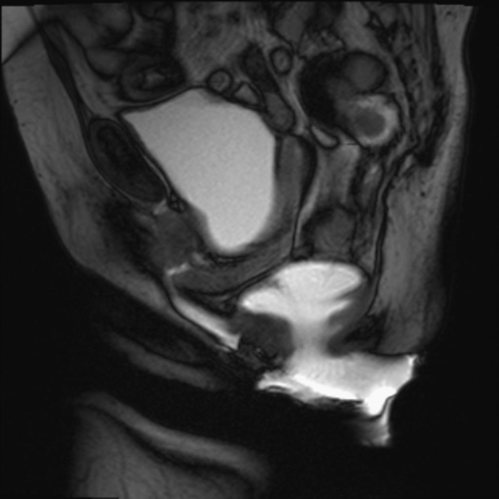 Fig. 43: CINE RM - Defecatory phase Case 2 - Posterior pelvic floor dysfunction 56 year-old woman, with terminal obstipation During defecation, a significant rectocele is formed, accompanied by
