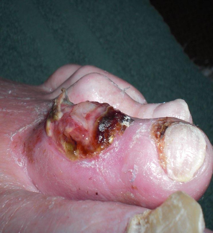 Signs and symptoms of wound infection Abnormal granulation tissue Bleeding from friable granulation tissue at the surface Wound breakdown and enlargement