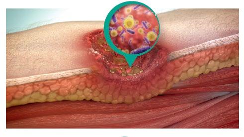 Case reports introducing Sorbact technology Cutimed Sorbact dressings (in a moist wound bed)