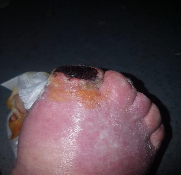 Case report one post-operative wound infection
