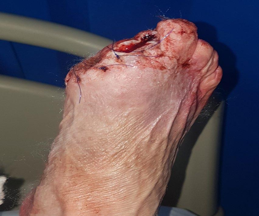 Case report one continued On clinical examination, the toe was necrotic and there was evidence of infection and a high risk of systemic infection Vascular duplex showed no significant arterial