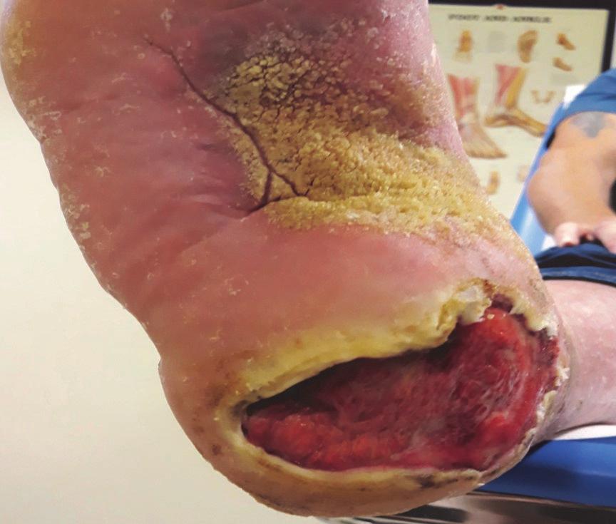 Case report two post-operative wound infection following toe amputation Although from appearance there did not appear to be signs of infection, the wound was increasing in size and tracking 4cm to