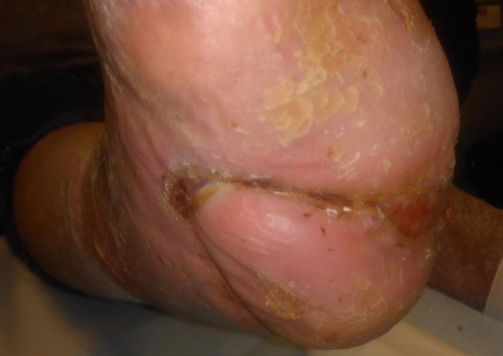 Case report two continued By week 14, the wound had completely healed with no recurrence of infection or need for antibiotic therapy The patient s quality of life had improved considerably, and he