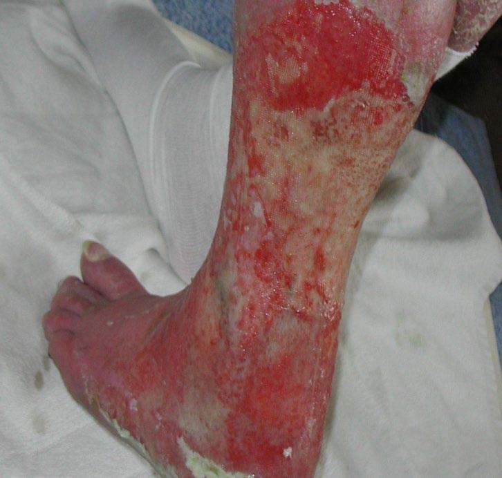 Antibiotic resistance Antibiotics alone should not be used routinely for the promotion of wound healing.