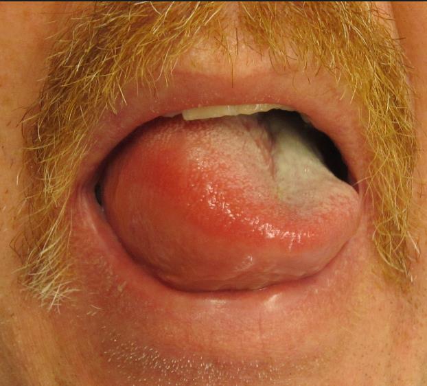 Angioedema Diffuse vasodilation and increased vascular permeability Signs/Symptoms: Asymmetric, non-pitting edema of the subcutaneous or submucosal tissues of the lips, tongue, and face