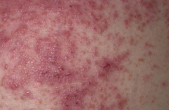 Cellular mediated Example Symptoms: Common drugs: Contact dermatitis (topical induction and elicitation of sensitization by a drug is limited to the skin) Delayed cutaneous eruptions (maculopapular