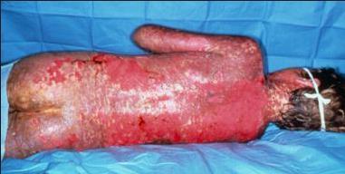 Steven s Johnson Syndrome (SJS) / Toxic Epidermal Necrolysis (TEN) Image: http://emedicine.medscape.