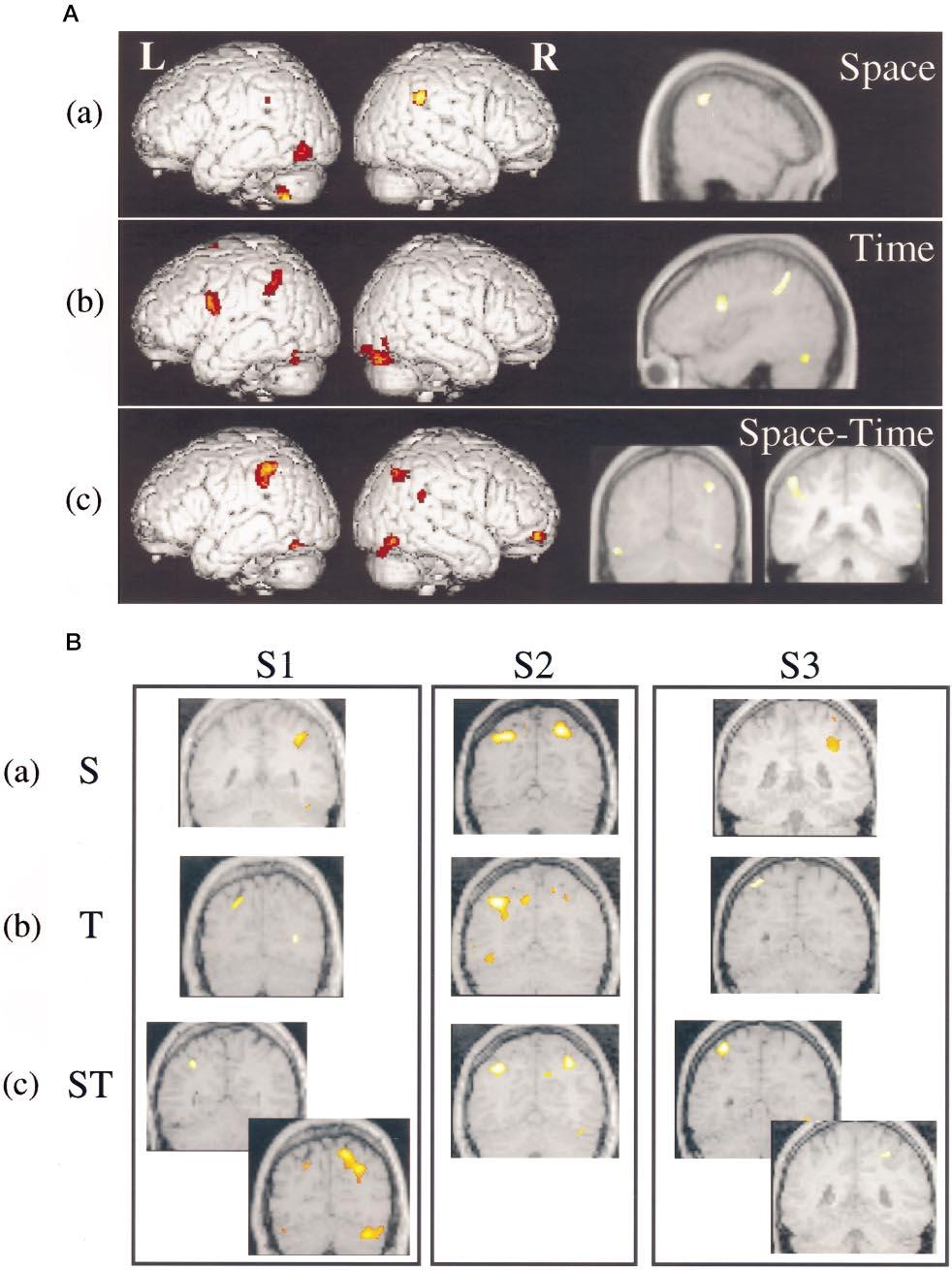 7432 J. Neurosci., September 15, 1998, 18(18):7426 7435 Coull and Nobre Hemispheric Lateralization for Attention to Space or Time Figure 3.
