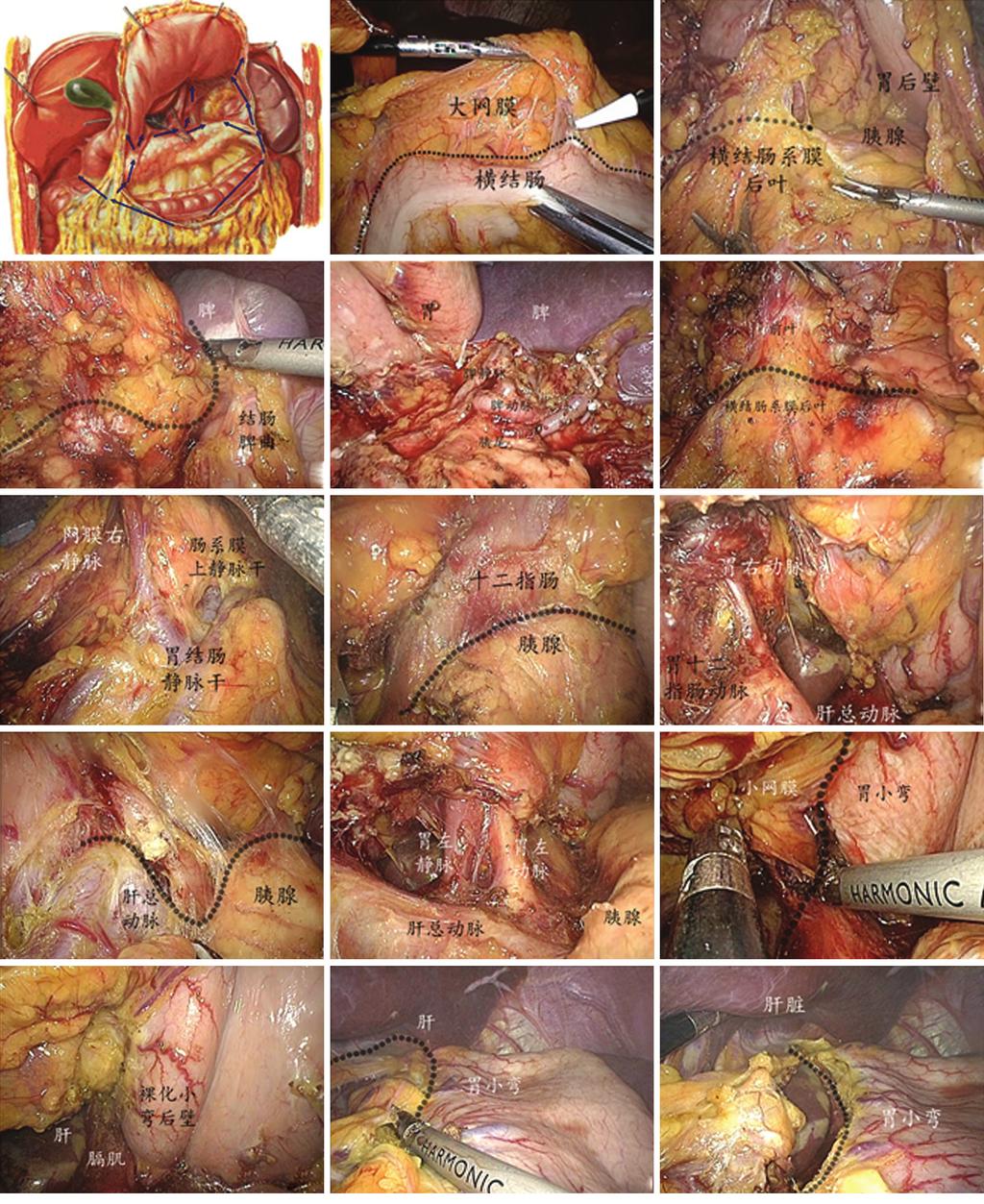 Translational Gastrointestinal Cancer, Vol 2 Suppl 1 June 2013 75 A B C D E F G H I J K L M N O Figure 2 A. Dissection sequences by region; B,C.