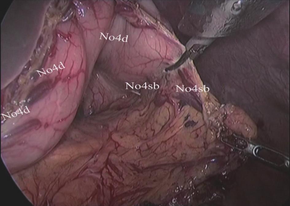 at its root (II) Dissociation of the gastric antrum and the lower region of pylorus: The gastric antrum was clamped by an assistant using an intestinal clamp with the left hand to the head side.