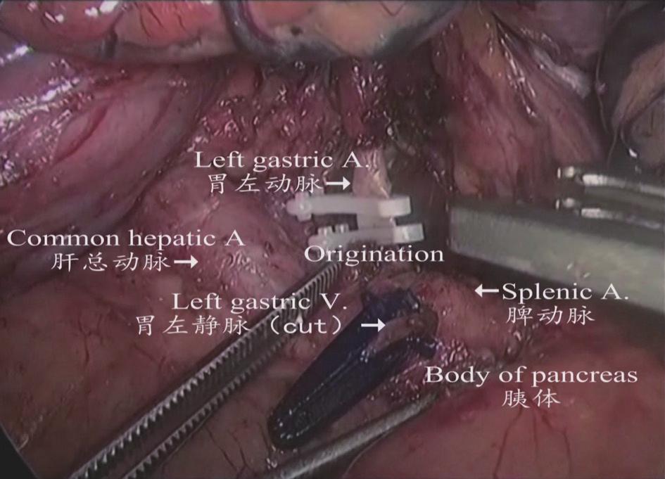 and right gastric artery were exposed Figure 9 Dissection of lymph node stations 8a, 11d, 9, and 7 after the common hepatic artery, splenic artery, and celiac trunk were exposed Figure 10 The lymph
