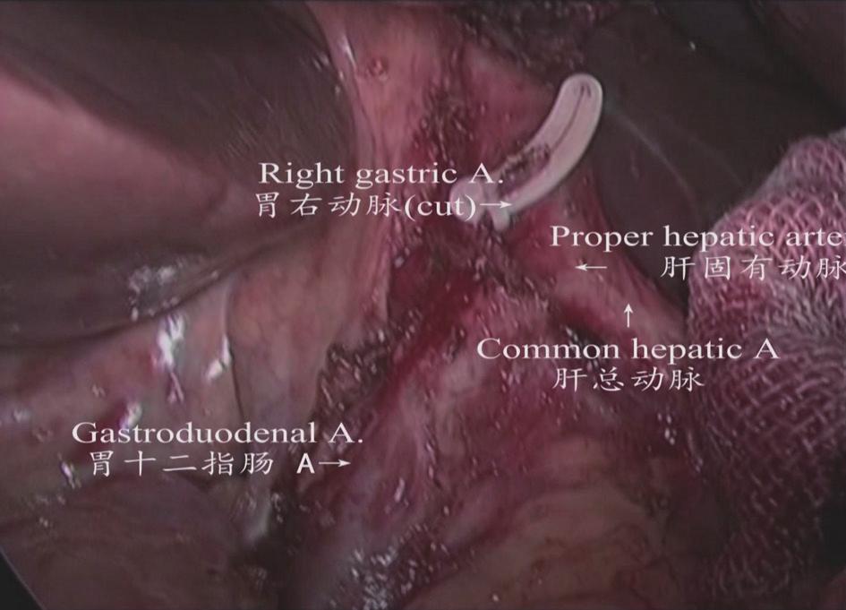 The right gastric artery was transected at the root segment to dissect the lymph node station 5 Figure 11 The lymphatic adipose tissue on the right side of the cardia was separated using an