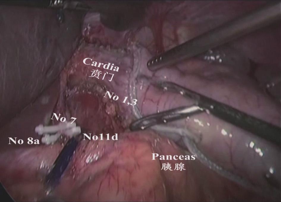 the pancreatic capsule was lifted.