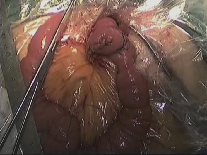 End-to-side anastomosis under direct vision was performed between the distal jejunal stump and stomach to reconstruct the digestive tract (VI) The duodenal stump, greater curvature and lesser