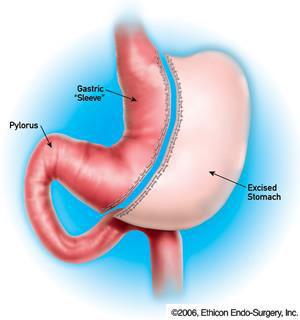 Steps of the Laparoscopic Roux-en-Y Gastric Bypass: 1) We gain access to the abdomen with ports for laparoscopic surgery 2) We make a new stomach pouch out of the top of your original (native)