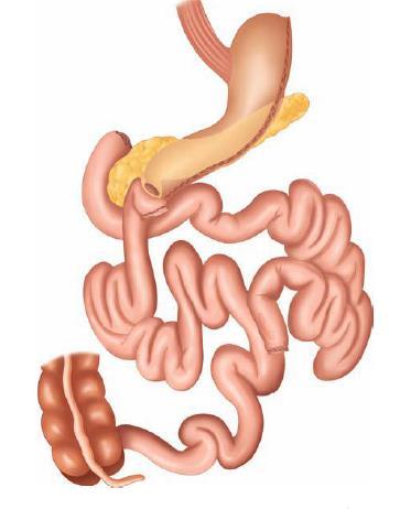 Biliopancreatic Diversion and Duodenal Switch The DS differs from BPD only in the proximal gut portion of the operation.