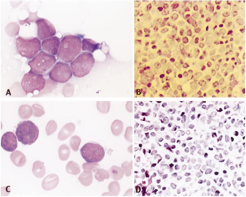 Figure. shown. epresentative morphology from case (A and B) and case 3 (C and D). Both bone marrow aspirate smears and biopsy samples are M. D. Anderson Cancer Center.