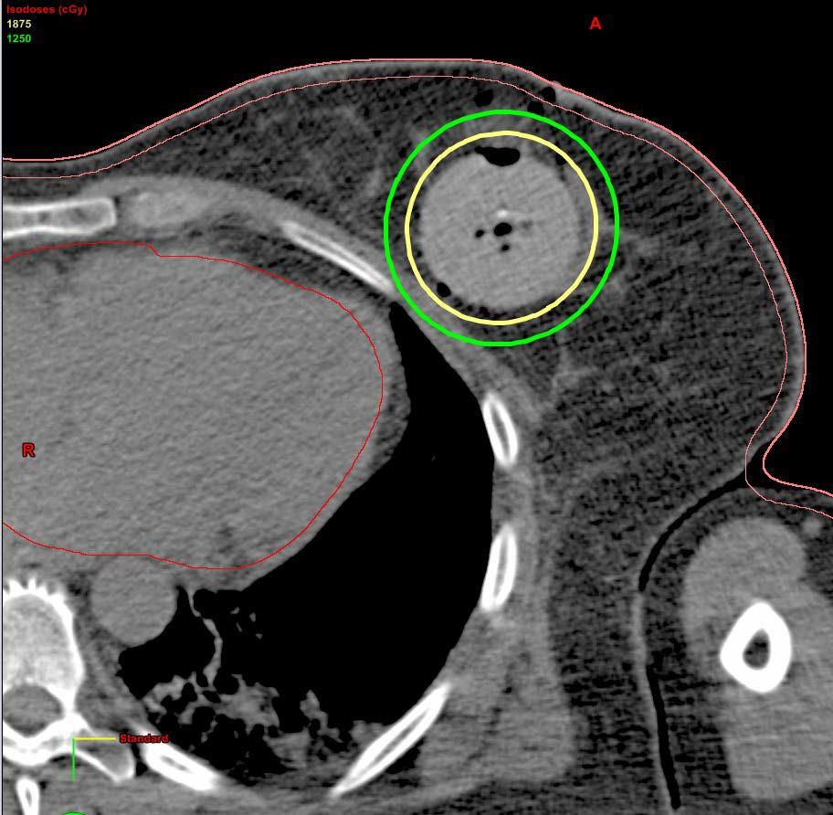 Precision Breast IORT: Imaging & Customized Treatment Planning CT acquired at time of lumpectomy; used for 3D computerized treatment planning Skin and ribs receive less than prescription dose