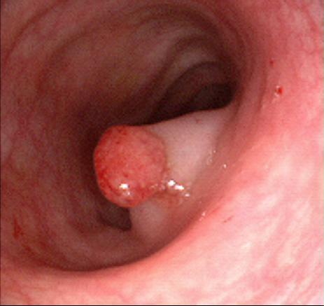 Benefits of Flexible Sigmoidoscopy Added screening option for average risk individuals Reduction in CRC incidence and