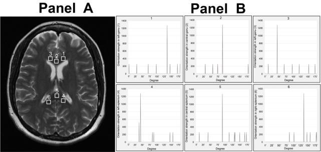 Fig. 83.3: Example orientation profiles calculated using our method from chosen corpus callosum ROIs. Panel A shows the same T2-weighted image and ROIs as seen in Fig. 2.