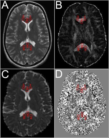 Fig. 205.2: ROIs selection in T2-weighted image and corresponding maps. (A) Top left panel shows six ROIs in left, center and right genu and splenium in T2-weighted image.