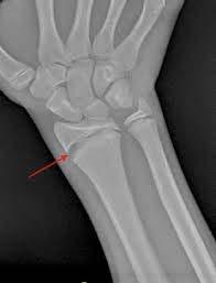 Case 1: Growth Plate Injuries Epiphysis/Physis is the growth plate where the bone is near a joint