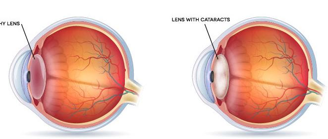 What are Cataracts? Cataracts are the clouding of the eye s natural lenses, and along with gray hair and wrinkles, cataracts are part of the inevitable aging process.