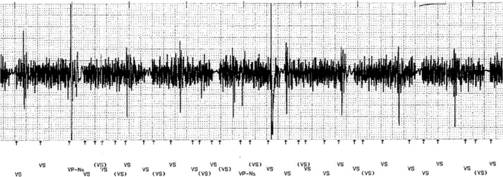 MRI-Induced Noise High-frequency noise and noise response ventricular pacing are noted on the bipolar ventricular channel