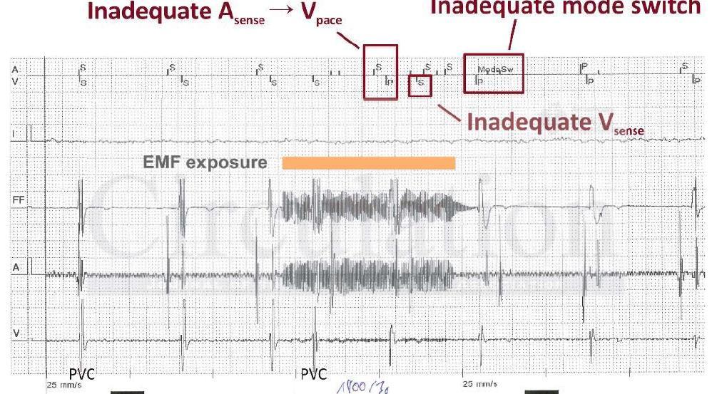 EMF exposure: inapporpirate atrial oversense and inappropriate V pacing,