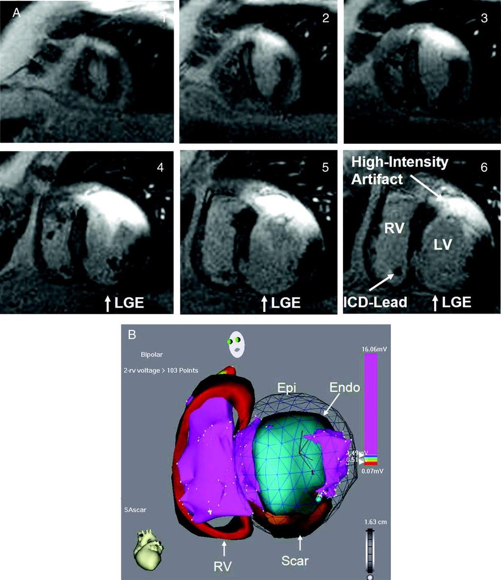 MRI and extraction of anatomy in patients with ICDs.