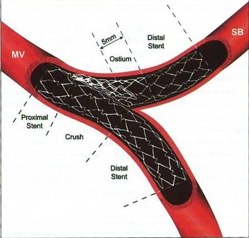 Crush Technique Wiring of both MV and SB. Predilatation of MV and/or SB (optional but recommended). Stenting of the SB first, with an un-inflated stent (or balloon) positioned in the MV.