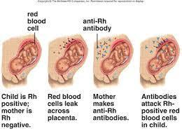 the placenta and attach to the red blood cells in the baby and destroy them, and the baby will have hemolytic anemia, jaundice, and other
