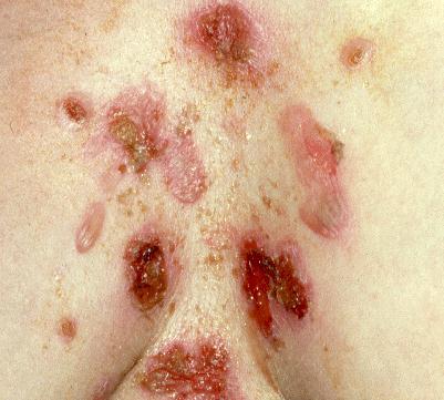 Pemphigus vulgaris, the most dangerous bullous skin disease.