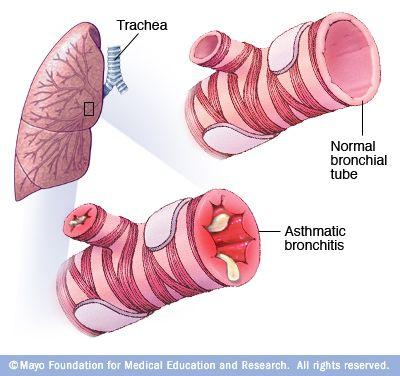 Etiology l Asthma is a chronic disease which affects the bronchial tubes that lead into the lungs Incubation period: